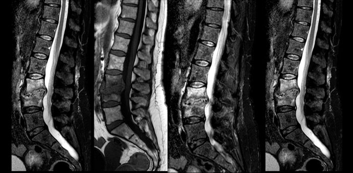 Discitis o espondilodiscitis - Cirugia de columna